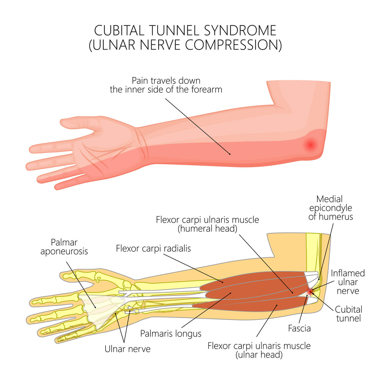 nerve-compression-conditions-form-hand-therapy